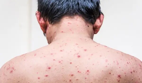 علائم آبله‌مرغان در بزرگسالان